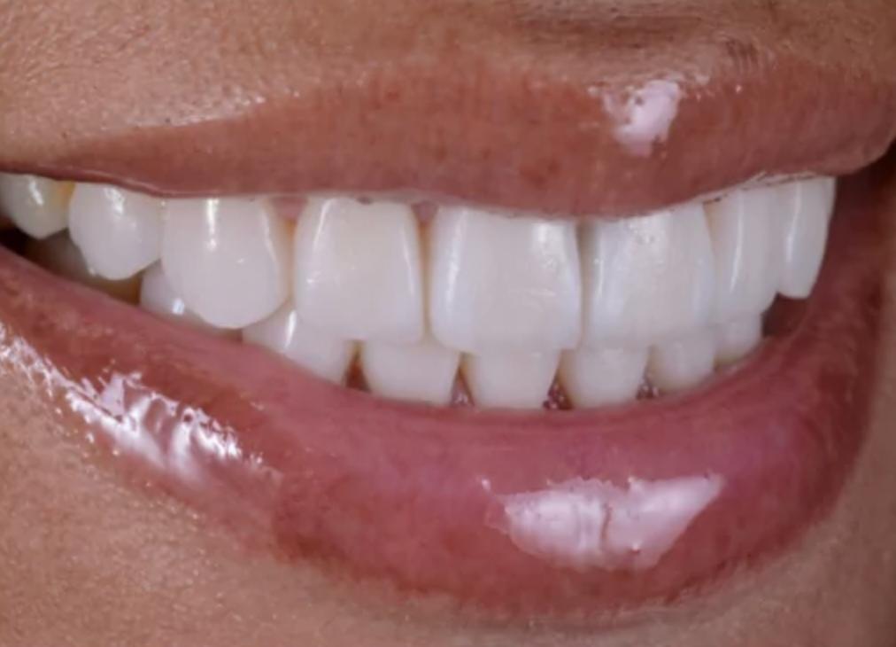 Teeth after using Lumineux strips