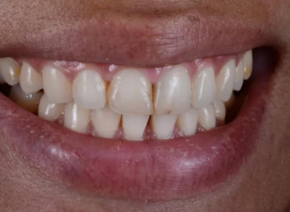 Teeth before using Lumineux strips
